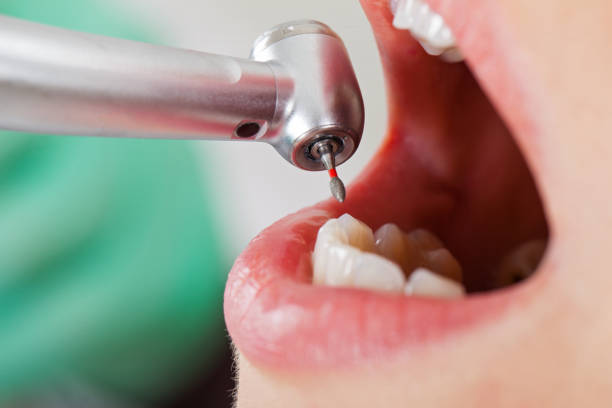 Best Emergency Dental Extractions in Glenns Ferry, ID